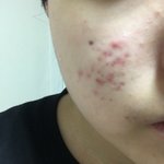 (<b>살짝</b> 혐일수도 )나 여드름 좀 구해줘 제발..