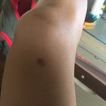 [댓글부탁해] 약혐) 무릎 대였는데 <b>물집</b> 어케 ㅠ