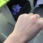 얘들아 이거 <b>습진</b>이야?