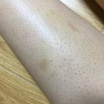 (혐) 이거 <b>모공</b>각화증인가요? ㅠ