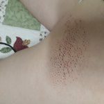 [19] __이_같은<b>흉터</b>어떻게해