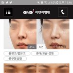 [드루와] <b>이</b> <b>수술</b> 괜찬을까?