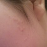 [조언부탁해] 이런 뾰루지? 트러블? 은 어떻게없애?