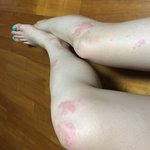 [꼭댓글부탁] [사진有]<b>야외테이블</b>에서 치킨 먹었는데 다리에ㅠㅠㅠ