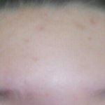 [조언부탁해] 이거 여드름인가
