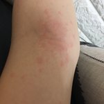 [댓글부탁해] 워터<b>파크</b> 두드러기 도와줘 ㅠㅠㅠㅠ제발