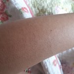 [댓글부탁해] <b>닭살</b>피부 나보다 심한애들있냐 (혐주의