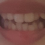 [조언부탁해] 애들아 <b>치아</b>교정 어떡하지 ㅠㅠㅜ