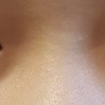 [조언부탁해] <b>눈</b>밑지방 <b>수술</b>해본사람있어?