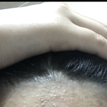 [드루와] 혐주의 피부 <b>예전</b>엔 완전 심각쓰했네
