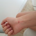 에어비앤비 화장실에 갇혔다가 발이 부러졌습니다. 1년째 무시하는...