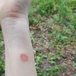 [아기<b>피부병</b>] 강아지 분양을 받았는 데 아기,한테 <b>피부병</b>이 전염됐어요...