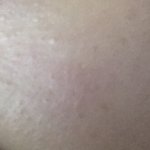 피부이거 어케 <b>제거</b>해야되?(혐주의