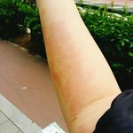 [드루와] 얘들아 내 팔에 빨간점