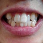 (혐주의)나보다 치열 <b>삐뚤</b>한사람??