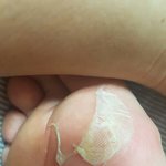 [댓글부탁해] 발바닥 <b>허물</b>벗는중