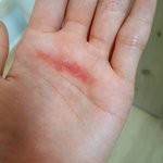 [댓글부탁해] 얘들아 손바닥에 이거 언제 <b>사라</b>질까