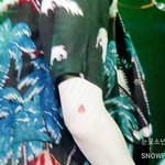 [EXO] 아 <b>쒸</b><b>이</b>이이이팔 준면이 진짜 다쳤나봄