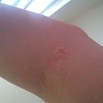 [개깊은빡침] 팔에 <b>나사</b> 박힌 줄..