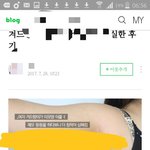 겨드랑이 <b>색소</b>침착 광고멘트 졸라극혐;