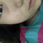 [도와줘] <b>눈밑</b>이 아프면서 땡땡 부었어 ㅜㅜ