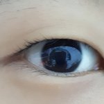 나 쌍수 성공할 수 있을까?