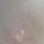 두드러기가 몇달전부터 계속올라옴ㅠㅠ 극혐