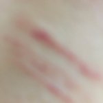 [19] <b>자해</b>흉터 없애는법좀