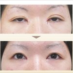 나 쌍꺼풀이 안 어울리는데 어떡하지