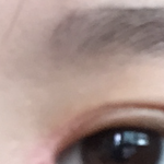 [조언부탁해] 앞트임 <b>흉터</b> 어떡해?ㅠㅠㅠㅠ