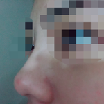 [조언부탁해] 나 코성형 할건데 ㅠㅠ