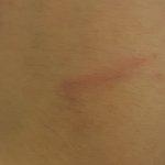 [드루와] 약간 혐짤)이거 상처 언제쯤 <b>사라</b>질까?