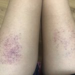 이거 <b>실핏줄</b>터진거 언제사라져..?(약혐)