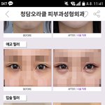입술이 너뮤얇아서 <b>필러</b>맞을라는데