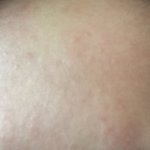 복숭아 알레르기 개쩌믄데 어떡해 ㅅㅂ