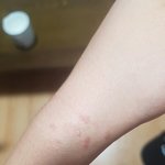 [댓글부탁해] 담배빵 했는데 <b>물집</b>생김