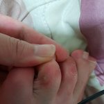 이거 티눈이에요? <b>사마귀</b>에요?