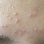 [조언부탁해] 얘들아 갑자기 이마에 <b>좁쌀</b>여드름나는데 이유가므ㅓ야??