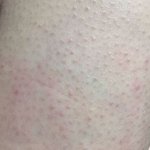 판녀들 닭살피부로 울고있나혀?(<b>feat</b> 모공각화증 꿀팁)