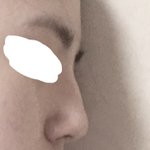 코끝<b>필러</b>? 암튼그거 맞으려는데 어때