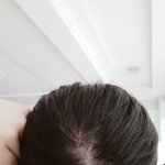 [댓글부탁해] 나 탈<b>모야</b>?