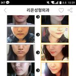 ㅋㅋㅋ강남언니 윤곽<b>주사</b>후기보는데