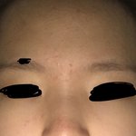이마에 난거 <b>좁쌀</b> 여드름이야?
