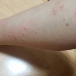 [댓글부탁해] 모기 ㅈㄴ<b>물림</b> 씹