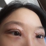 [드루와] 쌍수 매몰 <b>실밥</b>뺀거 후기