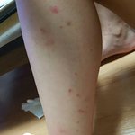 [댓글부탁해] <b>캠핑</b>갔다가 모기들에게 묻지마 폭행당함