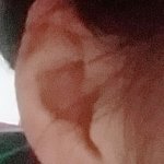 귓볼 뚫은지 2주 됐는데 부었을 때 어떡함..?