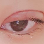 나 <b>쌍수</b> 했는데 눈 팅팅 부음