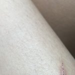 애덜아 이거 <b>흉터</b> 남을 것 같음?쪼꼼혐주의(자해아님)