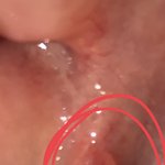 [사진약혐] 입안에 <b>물집</b>같은거 잇는데 ((((약혐)))